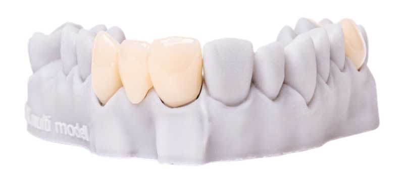 Impressions réalisées avec la résine dentaire 3D Freeprint Crown.