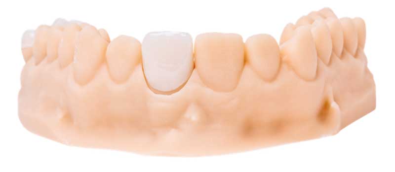 Impressions réalisées avec la résine dentaire 3D Freeprint Crown.