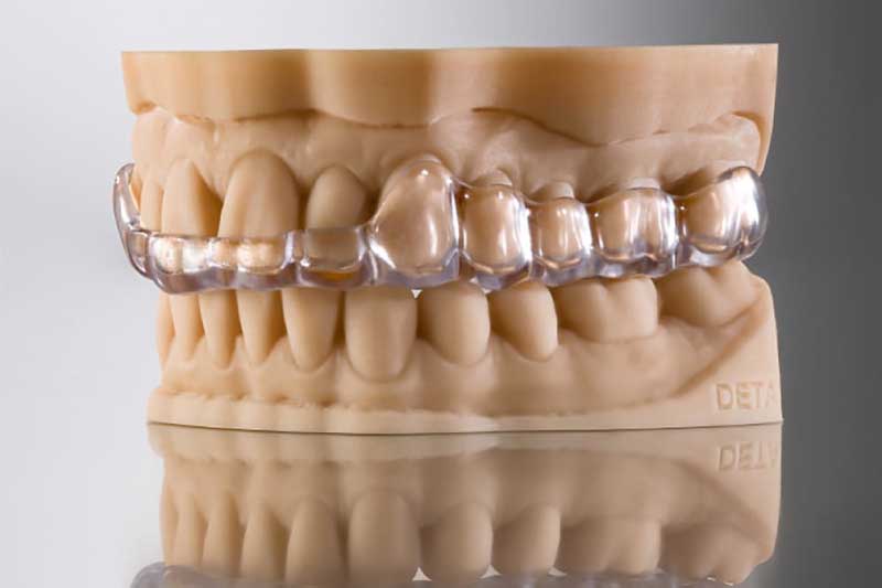Férula impressa com a resina dentária Splintmaster Taff