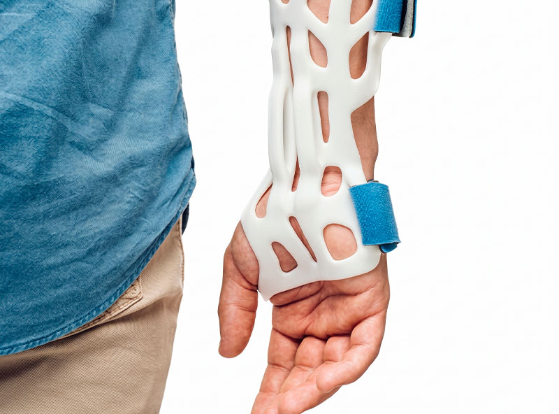Orthosis printed with PLA filament.