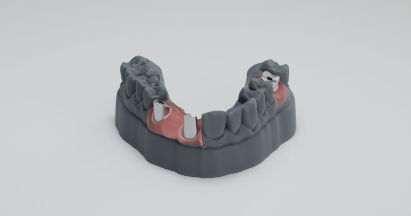 Different applications of the HeyGears UltraPrint Model WW UV dental resin