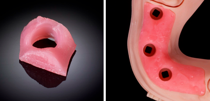 The KeyMask resin simulates the look and feel of real gum tissue
