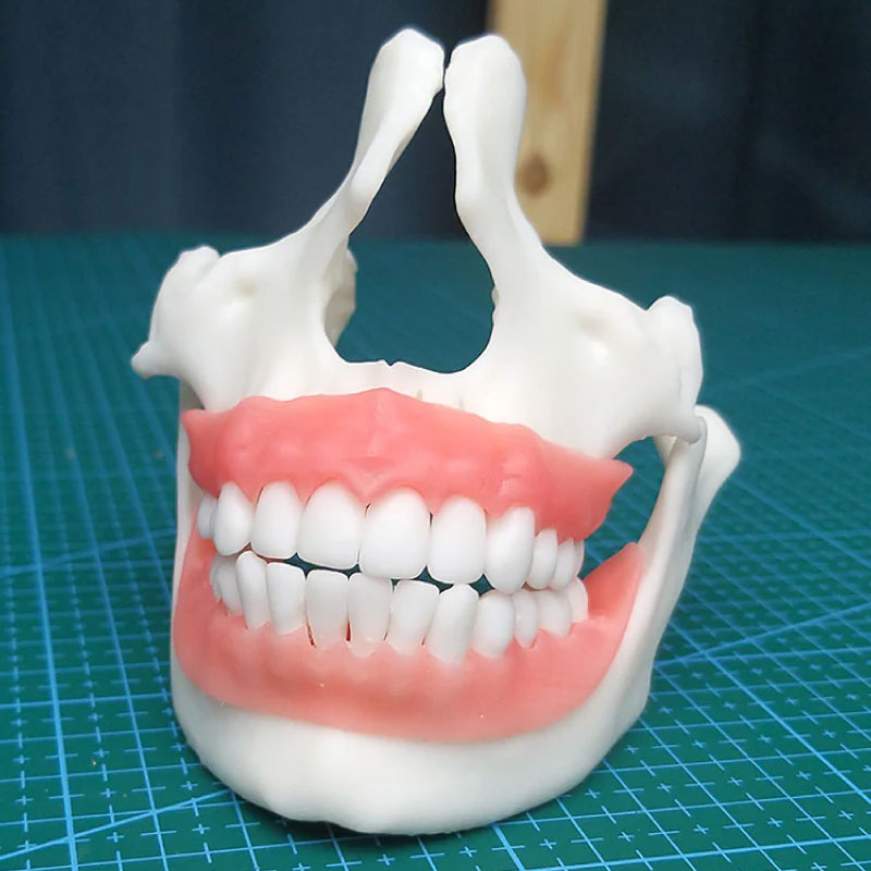 Example of a dental model with soft gingival tissue simulation.