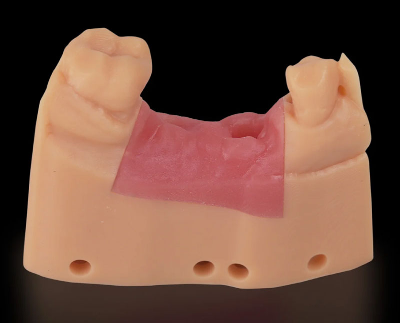 3D print made with F80 elastic gingival resin