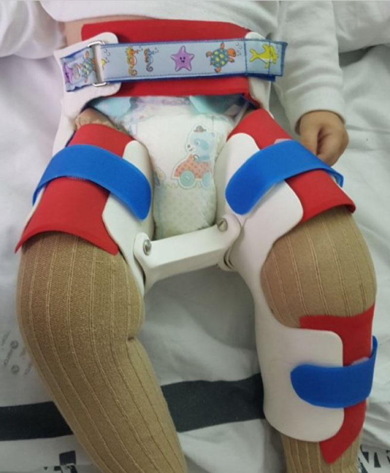 Suporte para fêmur de recém-nascido impresso com a WASP 4070 FX