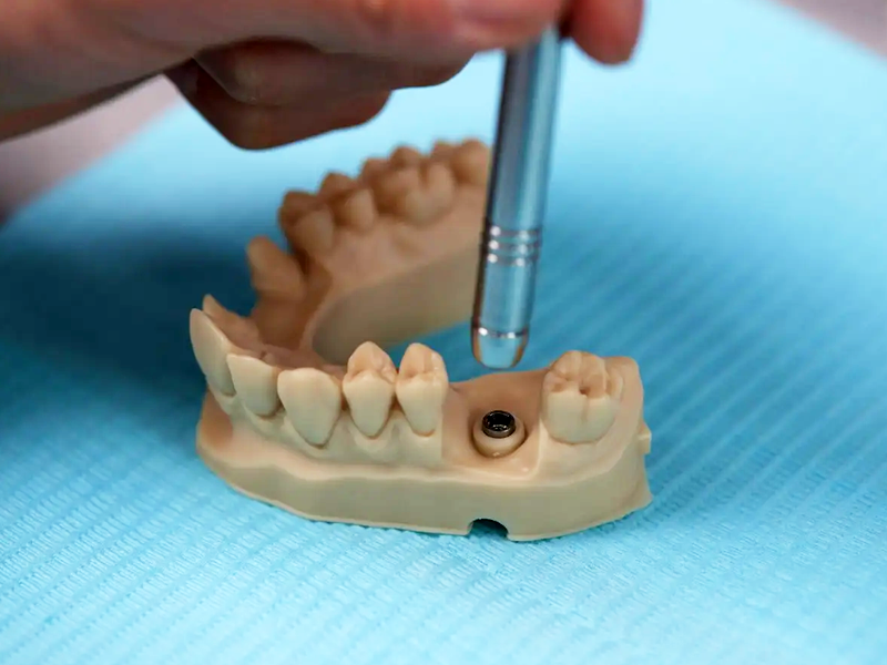 Placing an insert in a dental model printed with the Precision Model resin