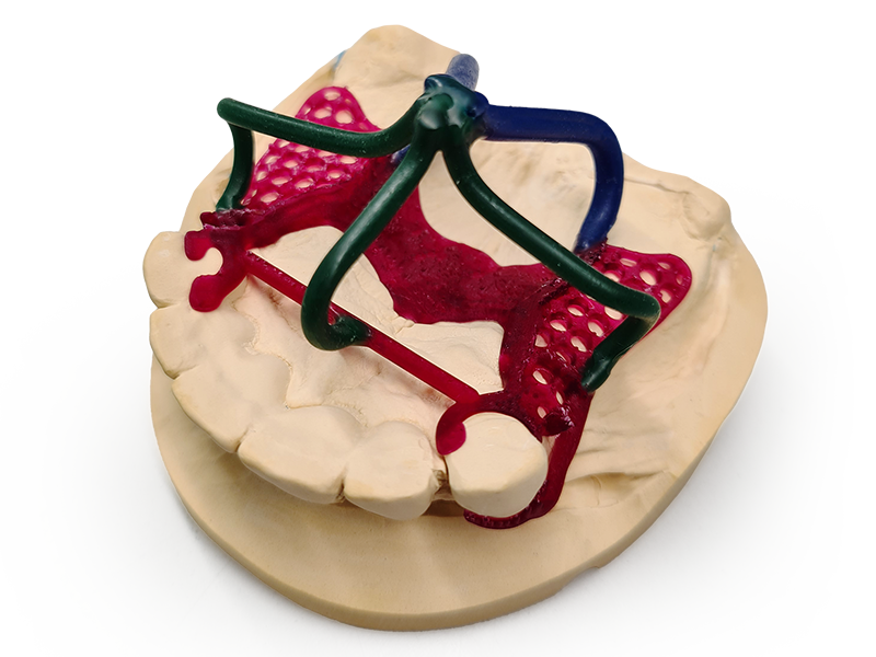 Estructura de malla de una prótesis parcial removible instalada en un modelo dental impreso en 3D