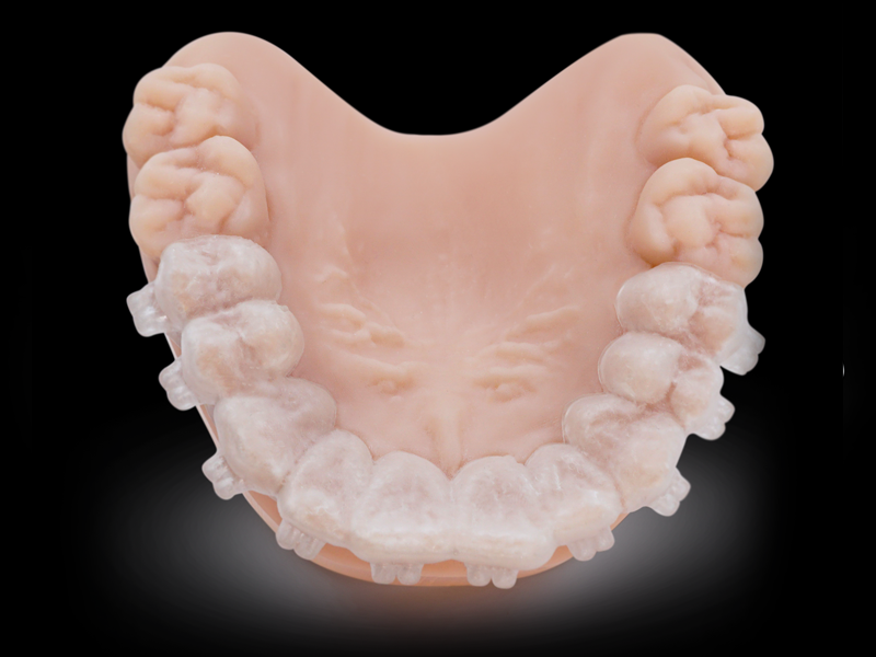 Una bandeja de unión indirecta impresa con la resina Dental IBT colocada sobre un modelo dental impreso en 3D