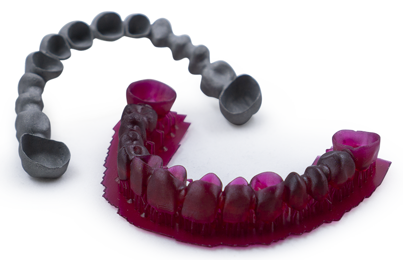 Mit HARZ Labs Dental Cast Resin hergestellter Zahnersatz